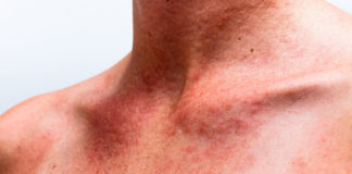 Irish people neglect to wear SPF during the winter months, skin expert warns of the misconception