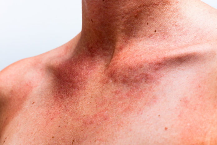 Sunburn Web Stock
