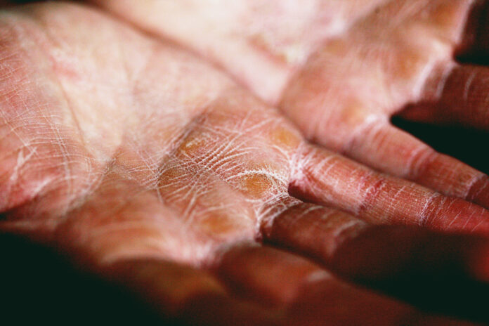 Eczema-unsplash-web stock@16-05-2023-12_14_50 copy