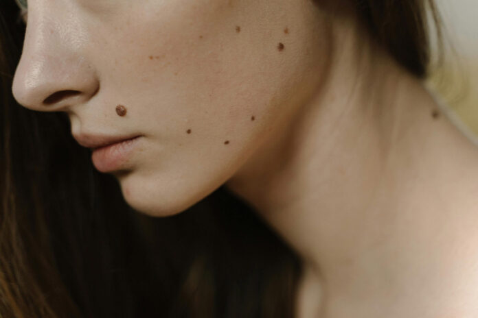Skin Moles-pexels-Web Stock@12-02-2025-21:26:51.jpg